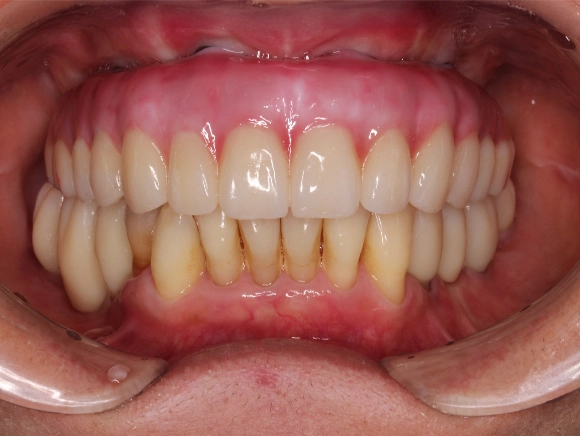 インプラント 治療後