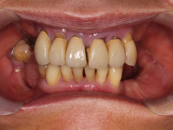 インプラント 治療前