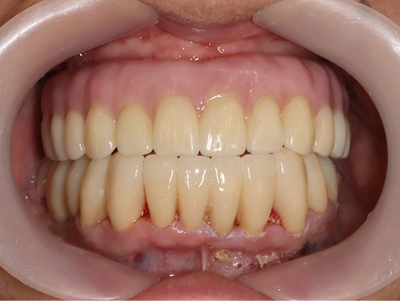 インプラント/セラミック治療 治療後