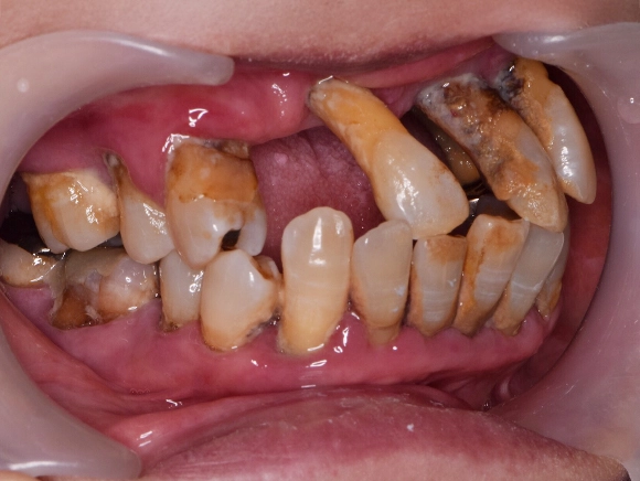 インプラント/セラミック治療 治療前