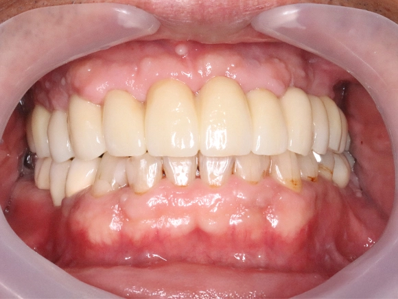 インプラント 治療後