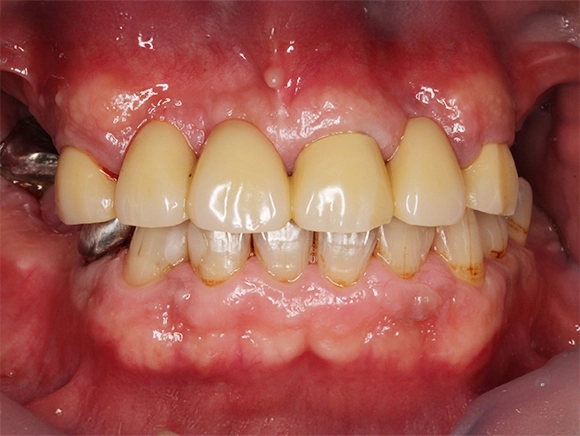 インプラント 治療前