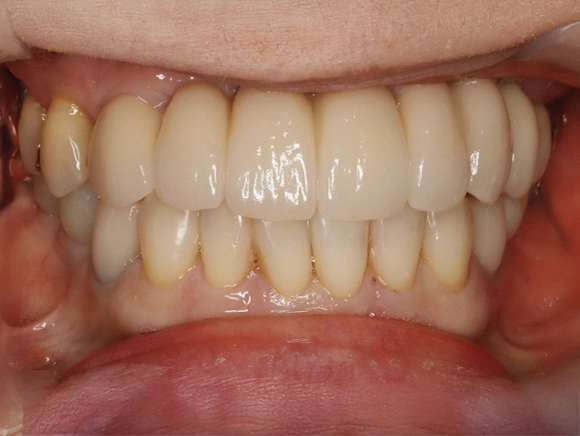 インプラント 治療後