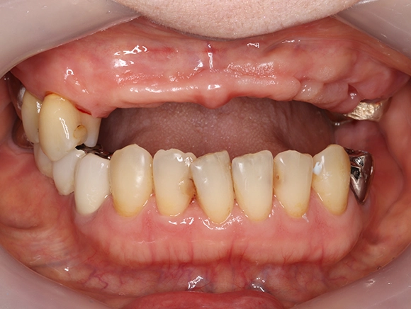 インプラント 治療前